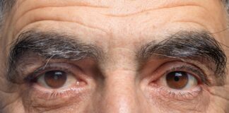 cataracts