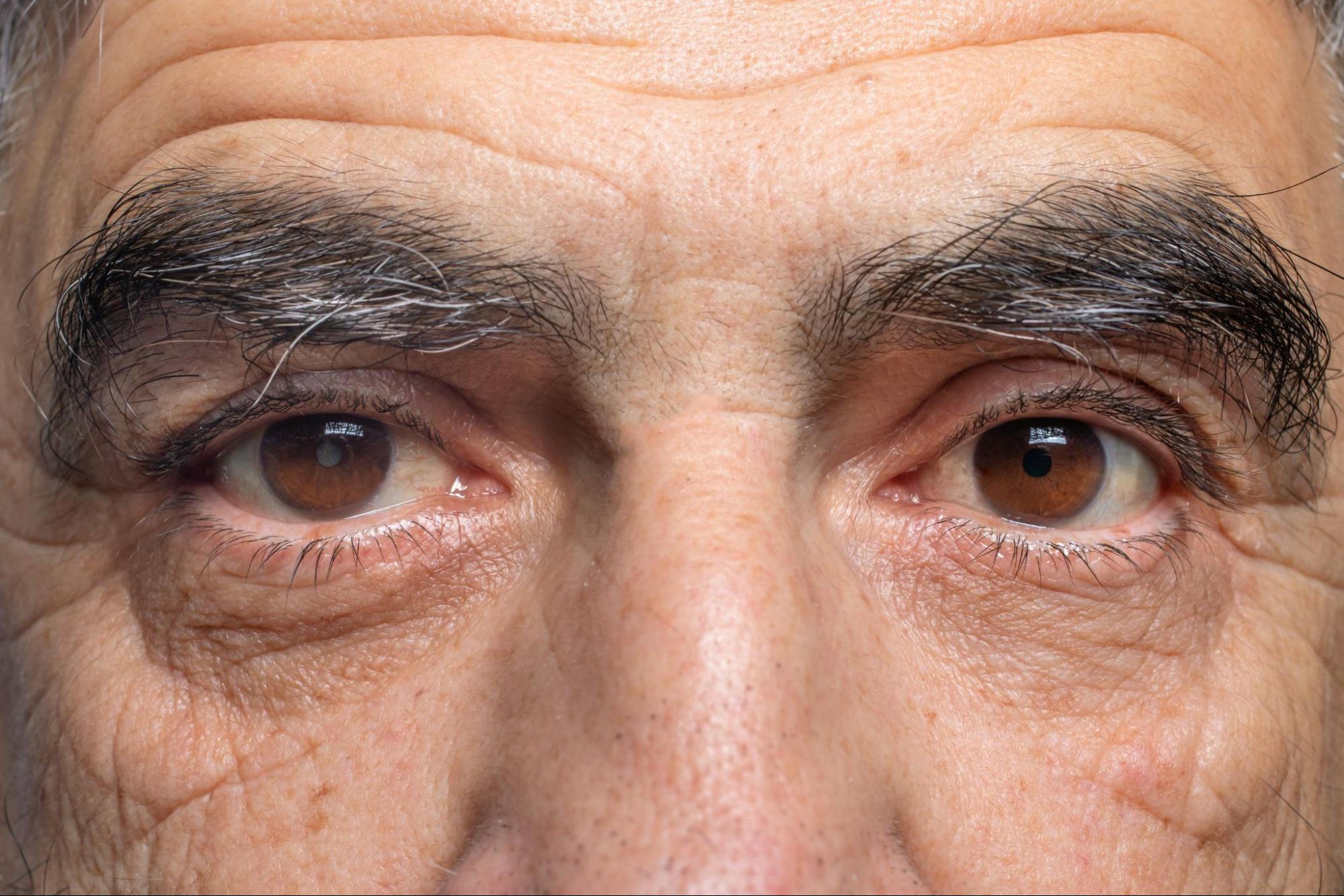 cataracts